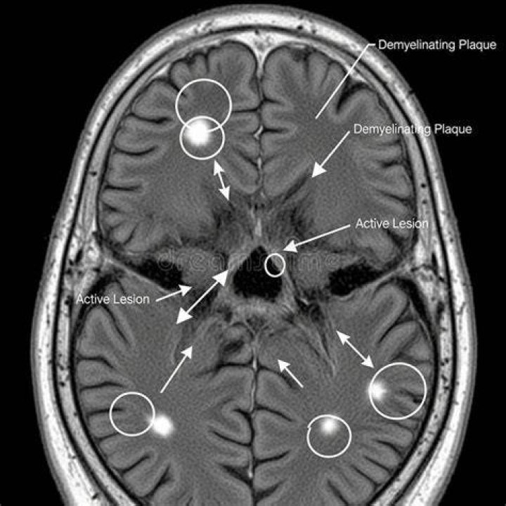 Does everyone with MS have lesions on the brain?