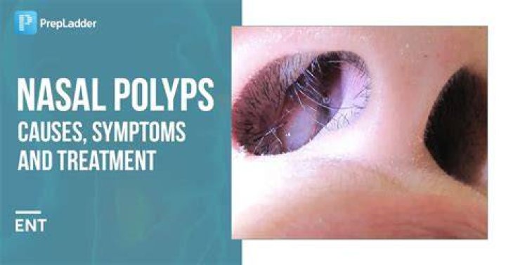 How do you stop nasal polyps from coming back?