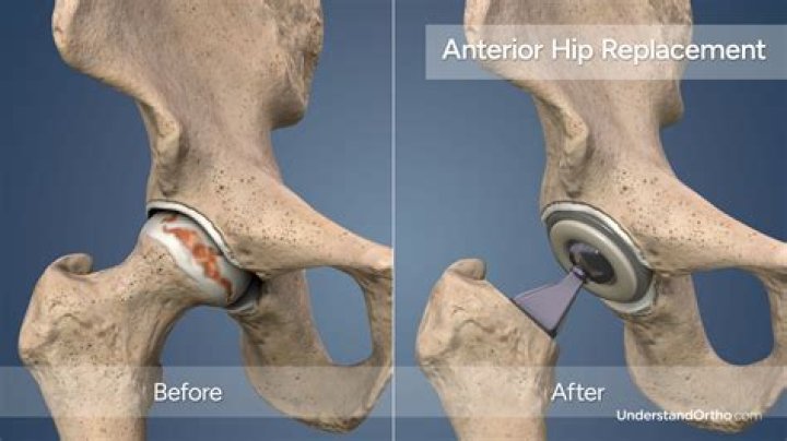How much exercise should I do after a hip replacement?