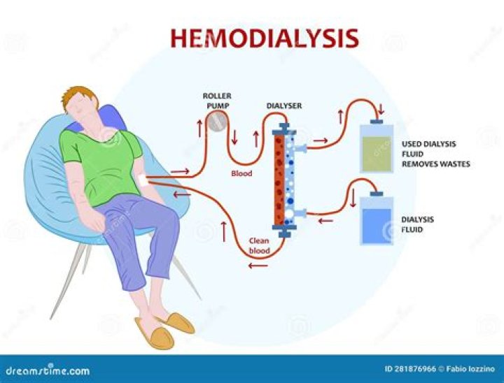 Is being on dialysis hard?