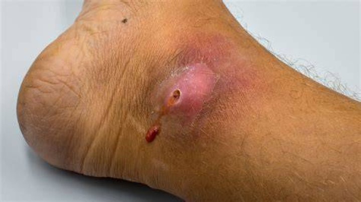 What does it mean if your wound is throbbing?