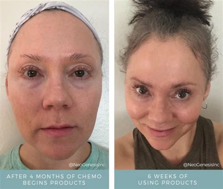 When do you lose your eyelashes during chemo?