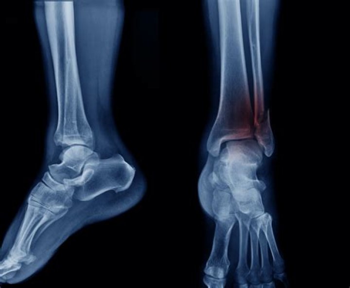 When should you get an xray for sprained ankle?