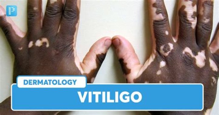 Why do Indians get vitiligo?